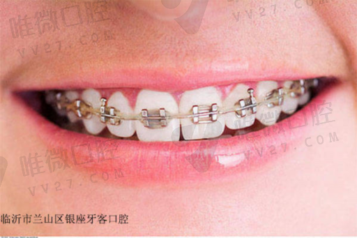金属矫正器是什么材料（牙齿矫正器一般是什么材质）(图1)